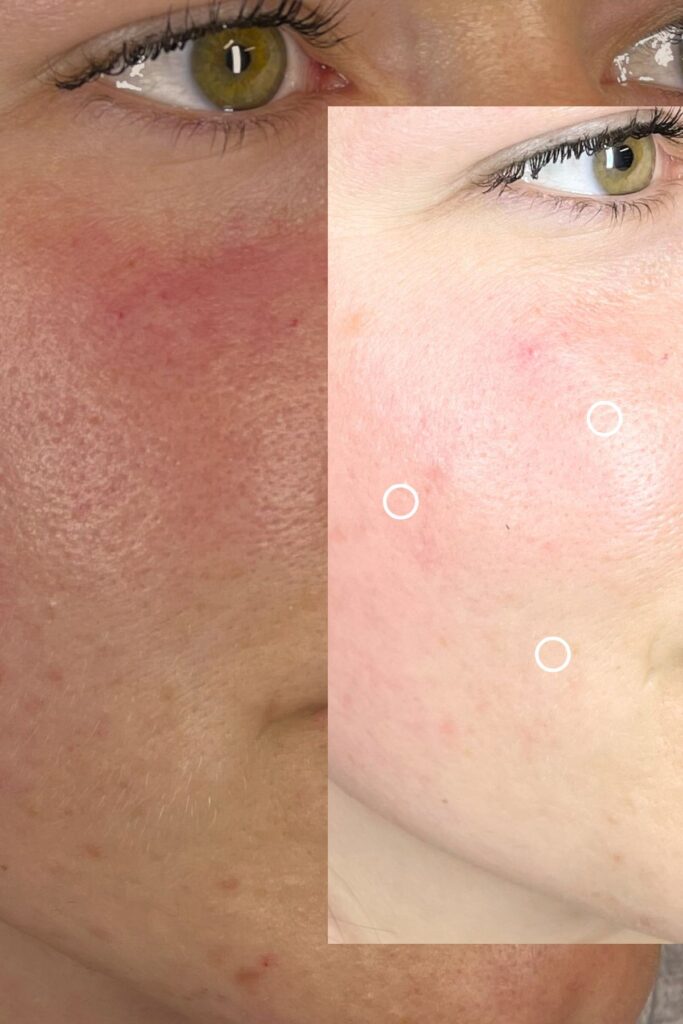 Espace_Beaute_Sublimage_epilation_facial_rougeurs