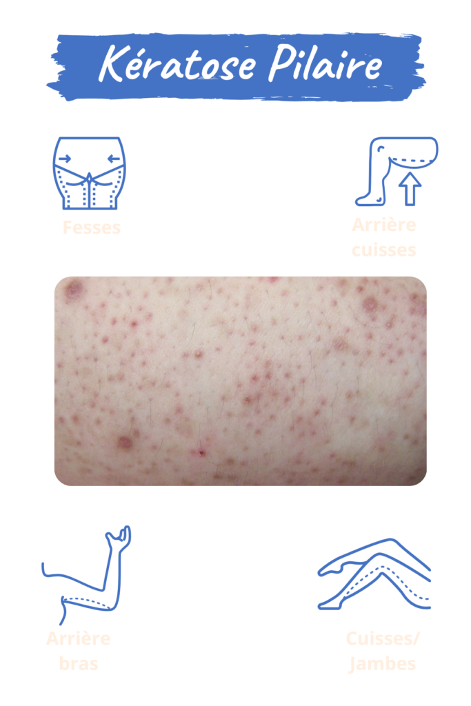 Espace_Beaute_Sublimage_epilation_keratose_pilaire (2) Kératose pilaire