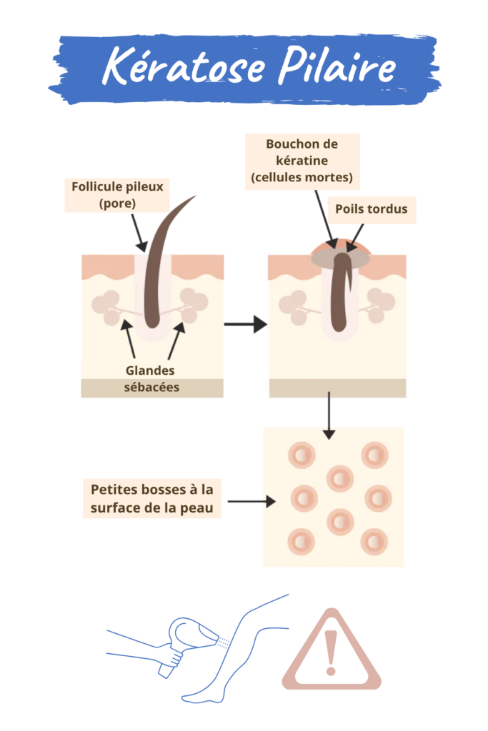 Espace_Beaute_Sublimage_epilation_keratose_pilaire Kératose pilaire