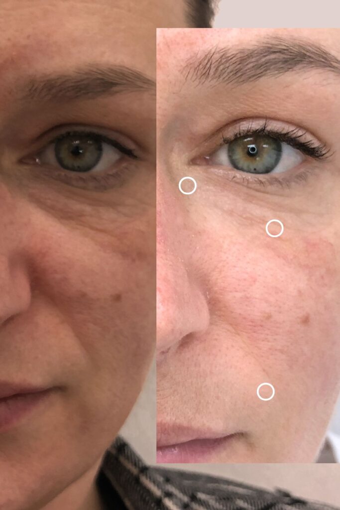 Espace_Beaute_Sublimage_epilation_microneedling