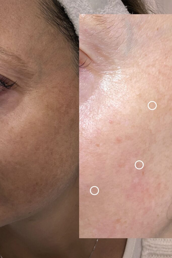 Espace_Beaute_Sublimage_epilation_microneedling (2)