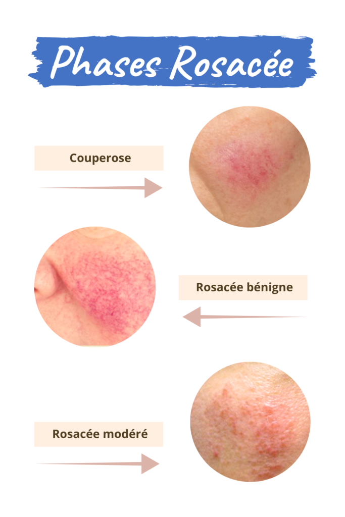 Espace_Beaute_Sublimage_epilation_rosacee