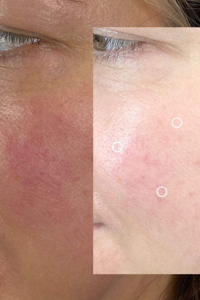 Espace_Beaute_Sublimage_epilation_thermocoagulation